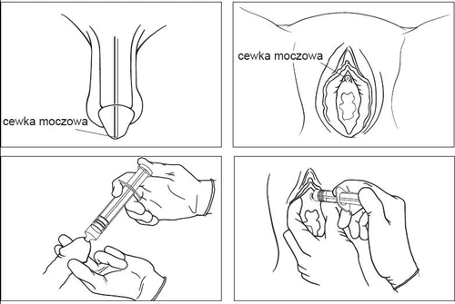 Чотири схематичних зображення анатомії та медичних ілюстрацій, що показують розташування сечівника у чоловіка і жінки, а також процес введення лікувального засобу шприцом