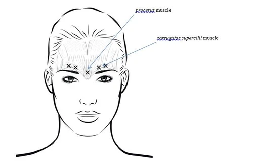 Схема обличчя жінки з позначеними м'язами procerus та corrugator supercilii за допомогою ліній і символів хрестиків на чолі