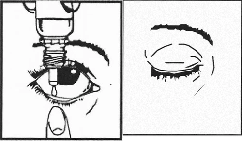 Illustration showing a drop of medication entering an open eye, and next to it a closed eye during the application process of an eye preparation