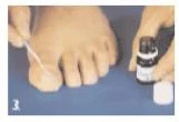Una mano che applica un preparato tramite pipetta su un dito del piede; accanto è posizionata una boccetta aperta con farmaco e un tappo bianco su uno sfondo blu