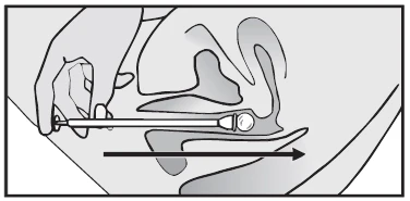 A hand holds an applicator and inserts it into the ear canal, advancing the device along the arrow into the depth of the canal