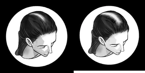 Two black-and-white illustrations showing a woman's head in profile, with visible areas of hair loss on the crown and back of the head
