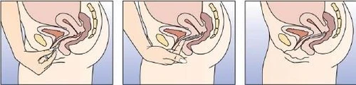 Tres esquemas anatómicos que muestran la mano introduciendo un aplicador con medicamento en el interior de la vagina para administrar el fármaco cerca del cuello uterino
