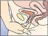 Esquema anatómico de las estructuras pélvicas femeninas con la mano introduciendo un aplicador en la vagina para colocar el medicamento dentro del cuerpo