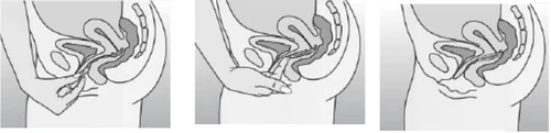 Tre schemi anatomici che mostrano il processo di inserimento di un tampone vaginale effettuato dalla mano in diverse fasi dell'applicazione all'interno del bacino