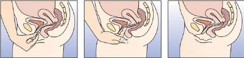 Three anatomical diagrams showing a hand inserting an applicator into the vagina to administer medication while lying on the side