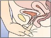 Анатомическая схема женских органов таза с видимой маткой, мочевым пузырём и влагалищем, а также рукой, вводящей аппликатор во влагалище