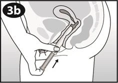 Schema del taglio trasversale del bacino che mostra una mano che impugna una siringa con ago introdotto nella vagina per somministrare un farmaco