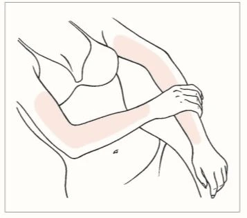 Schematic line drawing of a woman's torso with pink patches on the upper arms and forearm of the left arm