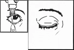 Esquema en blanco y negro que muestra una gota de medicamento cayendo en un ojo abierto, y un segundo cuadro que representa el ojo con los párpados cerrados