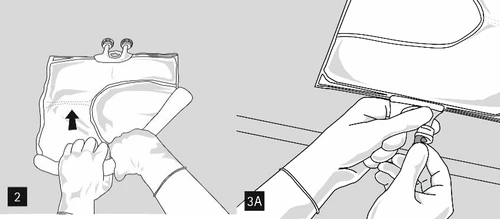 Gloved hands lifting a fluid bag and opening its flap, with one hand holding the cap at the infusion ports