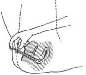 A hand holding an injection device applied to the skin for subcutaneous drug administration, with the subcutaneous area marked by hatching