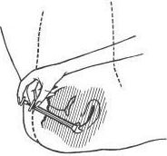 Una mano tiene la siringa e inserisce l'ago sotto un angolo nel tessuto sottocutaneo dell'addome, indicato da una linea tratteggiata guida