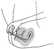Una mano sosteniendo la jeringa e introduciendo la aguja en ángulo dentro del tejido adiposo del abdomen, indicado con líneas discontinuas y rayado