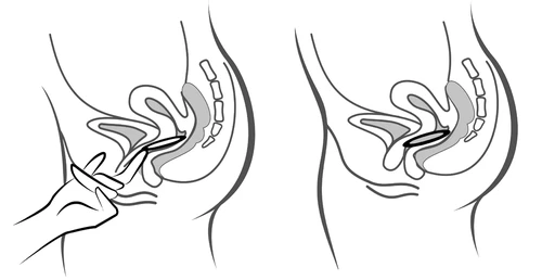 Dos dibujos esquemáticos del corte transversal de la pelvis femenina que muestran una mano con un aplicador introduciendo una pastilla en el interior de la vagina