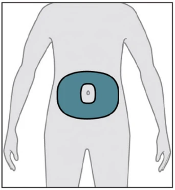 Schema della silhouette di una persona con un'area ovale scura evidenziata nell'addome intorno all'ombelico, indicante il sito di somministrazione del medicinale