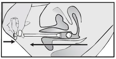 Illustrazione schematica che mostra l'applicazione di un farmaco nel naso tramite un nebulizzatore inserito nella narice, con la direzione della freccia rivolta all'indietro