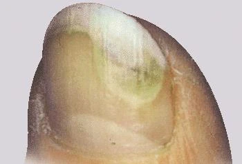 Primo piano su un'unghia del piede danneggiata con evidenti discromie giallo-verdastre e struttura ispessita e non estetica della lamina