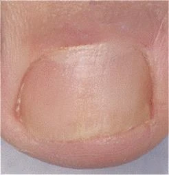 Primo piano su un'unghia del piede ispessita, giallastra e fragile con evidenti alterazioni della struttura della lamina e della pelle circostante