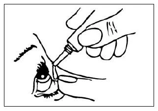 Una mano tiene una piccola bottiglietta con un contagocce, da cui una goccia di medicinale cade direttamente nell'occhio mostrato in primo piano