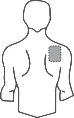Silueta humana del torso visto desde atrás con un parche gris rectangular marcado en el hombro derecho y dos líneas curvas en la espalda