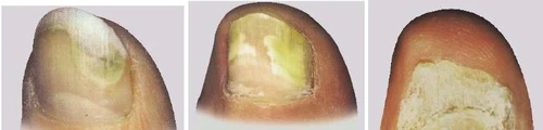 Three close-ups of fingers with damaged, yellowed, thickened nails having an irregular, flaking structure typical of fungal infection