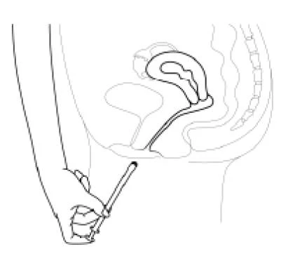 Anatomical diagram of the female pelvis showing the uterus and bladder, with a hand holding an applicator being inserted into the vagina