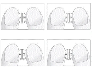 Cuatro ilustraciones esquemáticas de uñas con etiquetas A10, A11, A5, A5 que muestran diferentes etapas o tipos de cambios en las uñas en una instrucción médica