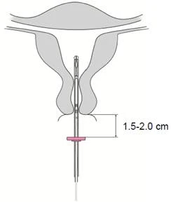 Schematic of administration of intrauterine device