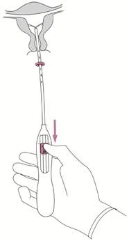 Hand holding a medical device with a downward-pointing arrow, inserting it into an anatomical diagram of female reproductive organs for a procedure