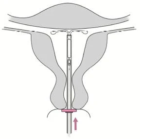 Schematic of intrauterine device insertion: device positioned inside the uterus, with an arrow indicating direction of insertion and visible fallopian tubes