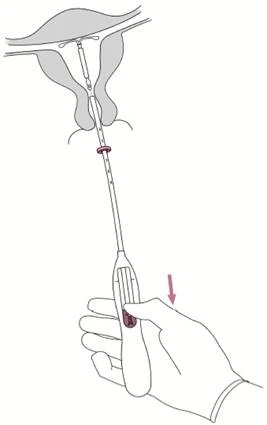 Hand holding a medical device with a long thin tube being inserted into the uterus, with a red arrow indicating the direction of movement