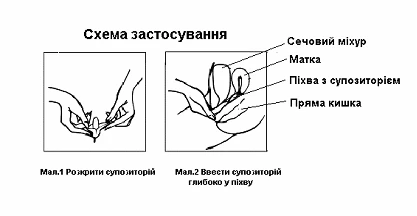 Схема применения суппозитория: вскрытие суппозитория и введение его глубоко в прямую кишку с обозначением мочевого пузыря, матки и прямой кишки