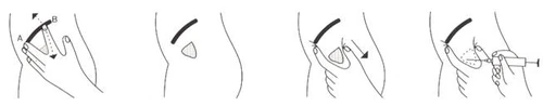 Injection instructions: hand positioning, lifting the skin, inserting the needle at an angle, and administering the solution into the muscle