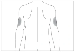 Rappresentazione schematica del corpo umano con aree evidenziate dei muscoli della spalla