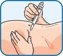 Una mano sostiene la jeringa en un ángulo de 45 grados, introduciendo la aguja en el tejido muscular del abdomen, mientras la otra mano mantiene la piel tensa
