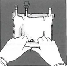 Due mani tengono un sacchetto trasparente contenente un liquido, collegato a due tubi con rubinetti, indicando la preparazione per un'infusione o una trasfusione