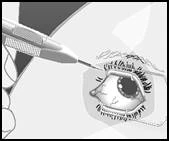 Una mano tiene una siringa inserendo l'ago nel bulbo oculare, con dettagli anatomici visibili dell'occhio e dei muscoli circostanti