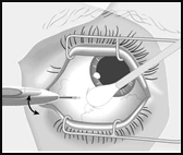 Uno strumento chirurgico viene inserito nell'occhio attraverso un'incisione sulla cornea, gli occhi sono tenuti aperti con appositi retractor, mostrato il processo di un'operazione oculare