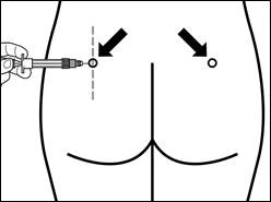 Hand holding a syringe injecting into the upper-outer part of the buttock, with arrows indicating the correct injection site