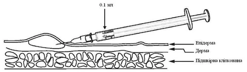 Una siringa inietta 0,1 ml di soluzione sotto la pelle, con indicazione dei livelli della pelle: epidermide, derma, tessuto sottocutaneo