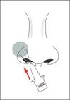 Un frasco pulverizador nasal se introduce en la fosa nasal en ángulo; una flecha roja indica la dirección de la administración. La imagen ilustra la técnica correcta de uso.